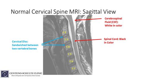 cervical spine mri results interpretation|Normal vs Abnormal Cervical Spine MRI .